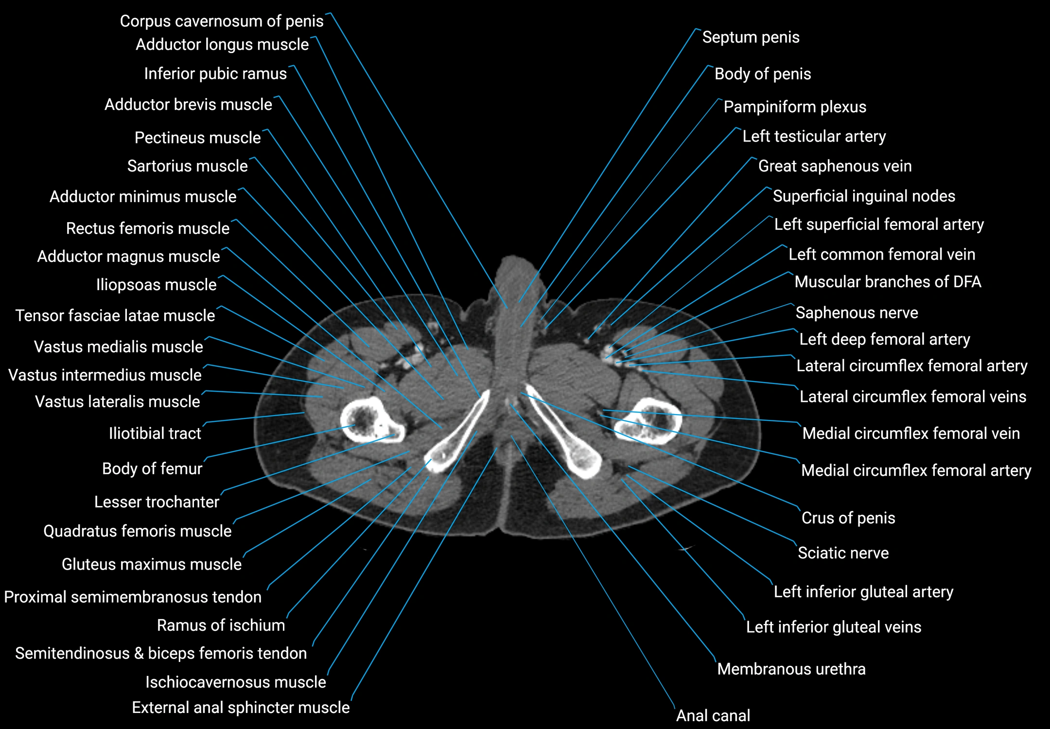 CT male pelvis axial cross sectional anatomy labelled radiology image -00214.webp